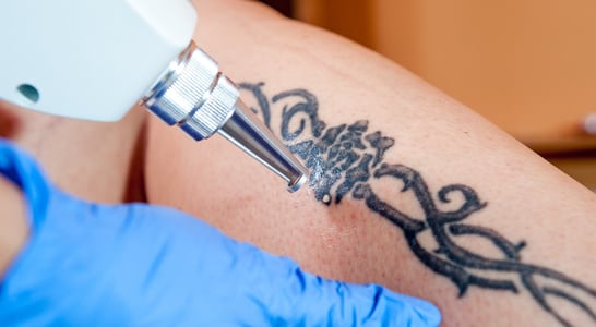 National Tattoo Removal Day