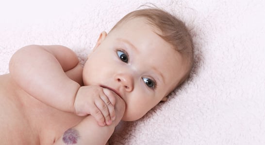 International Vascular Birthmarks Awareness Day