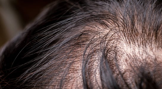 National Hair Loss Awareness Month