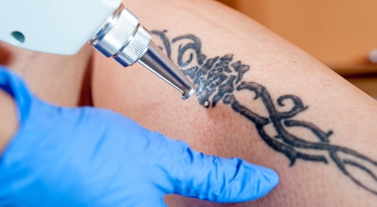 National Tattoo Removal Day