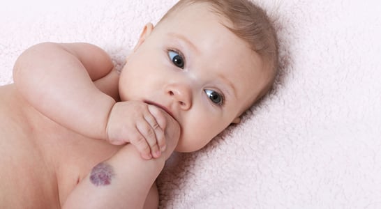 International Vascular Birthmarks Awareness Day