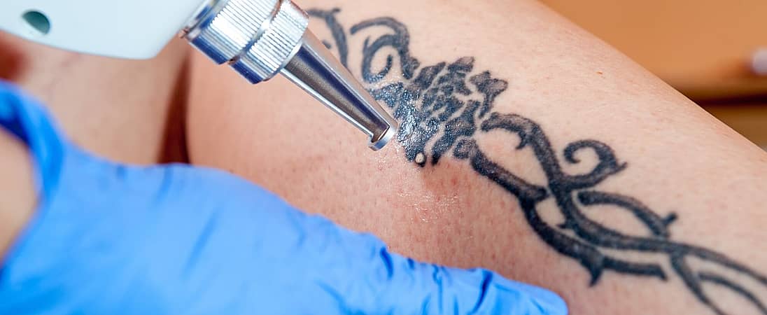 National Tattoo Removal Day