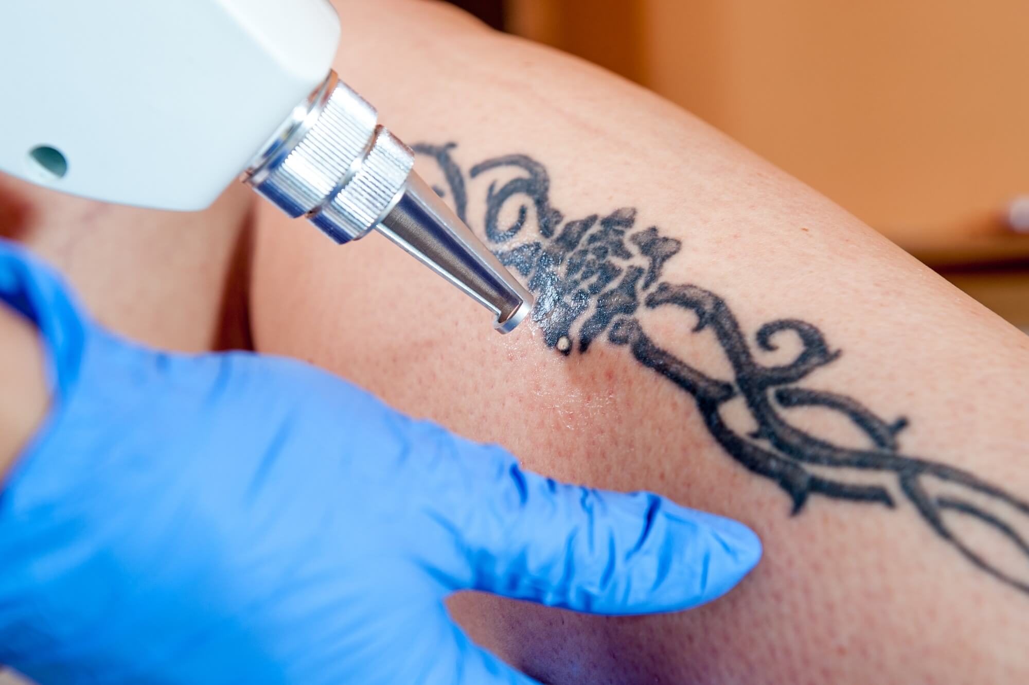 PicoSure Laser Tattoo Removal in Bellevue | VIVAA
